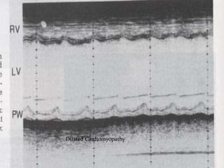 Dilated Cardiomyopathy
 