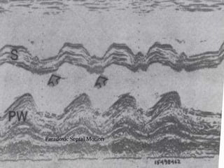 Paradoxic Septal Motion
 