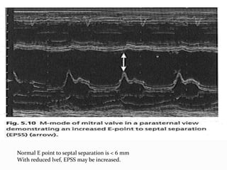 Normal E point to septal separation is < 6 mm
With reduced lvef, EPSS may be increased.
 
