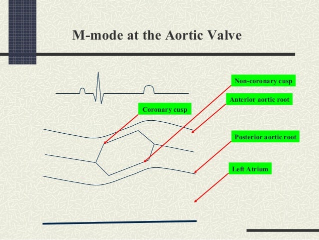 Mitral Valve Prolapse Diagnosed By Echocardiography Chest