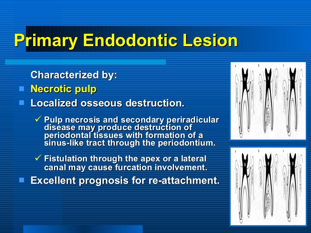 periodontitis associated with endodontic lesions