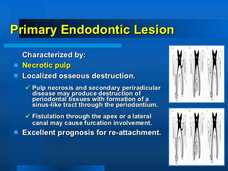 periodontitis associated with endodontic lesions
