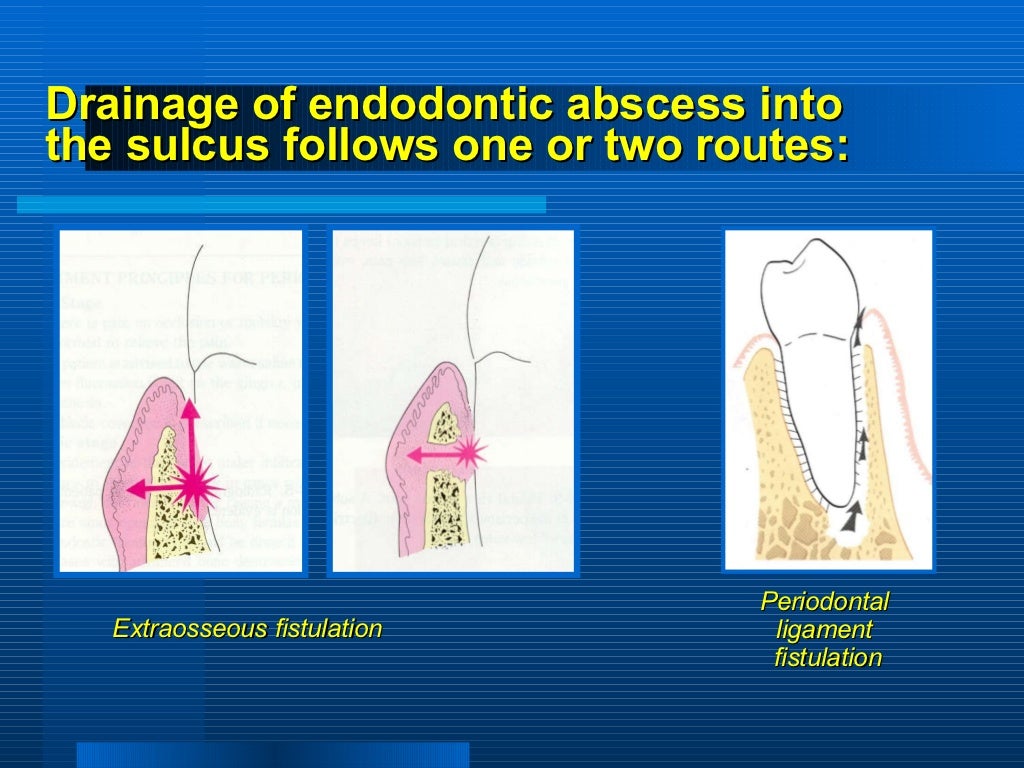 periodontitis associated with endodontic lesions