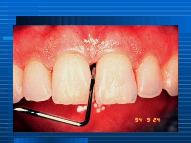 periodontitis associated with endodontic lesions