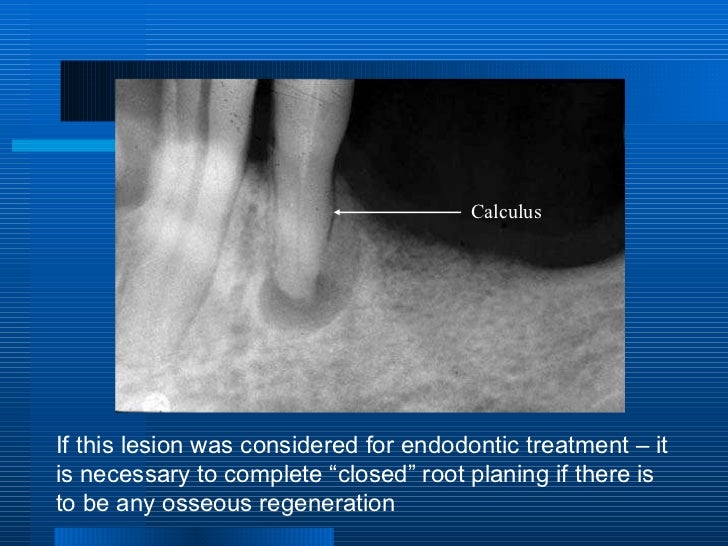 periodontitis associated with endodontic lesions