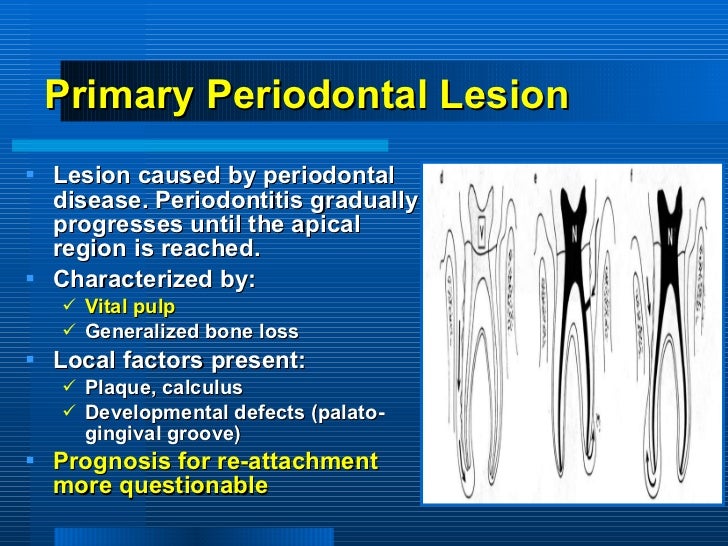 periodontitis associated with endodontic lesions