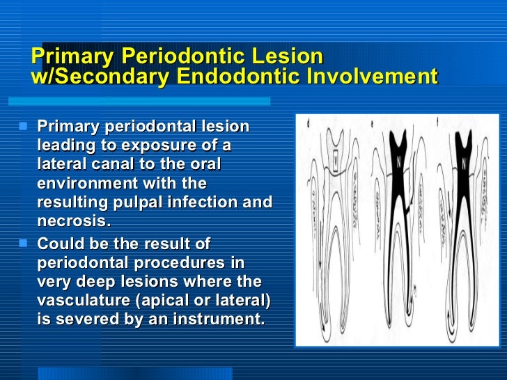periodontitis associated with endodontic lesions