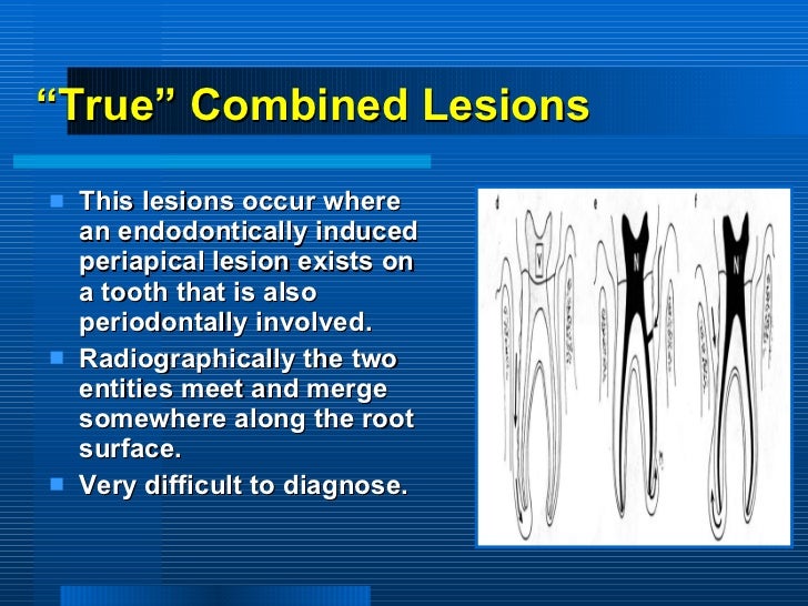 periodontitis associated with endodontic lesions