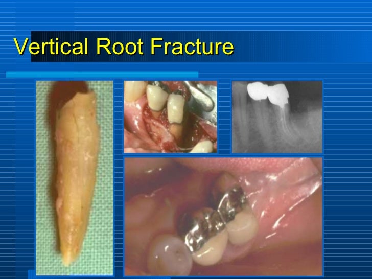 periodontitis associated with endodontic lesions