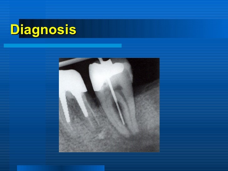 periodontitis associated with endodontic lesions