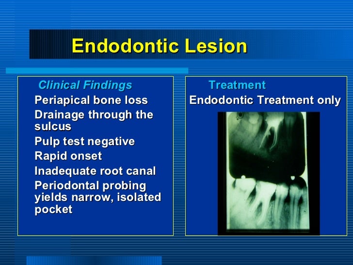 periodontitis associated with endodontic lesions
