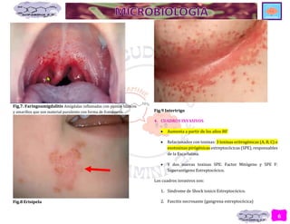 6
Fig,7. Faringoamigdalitis Amígdalas inflamadas con puntos blancos
y amarillos que son material purulento con forma de frambuesa.
Fig.8 Erisipela
Fig.9 Intertrigo
4. CUADROS INVASIVOS
 Aumenta a partir de los años 80’
 Relacionados con toxinas: 3 toxinas eritrogénicas (A, B, C) o
exotoxinas pirógénicas estreptocócicas (SPE), responsables
de la Escarlatina.
 Y dos nuevas toxinas SPE: Factor Mitógeno y SPE F:
Superantígeno Estreptocócico.
Los cuadros invasivos son:
1. Síndrome de Shock toxico Estreptocócico.
2. Fascitis necrosante (gangrena estreptocócica)
 