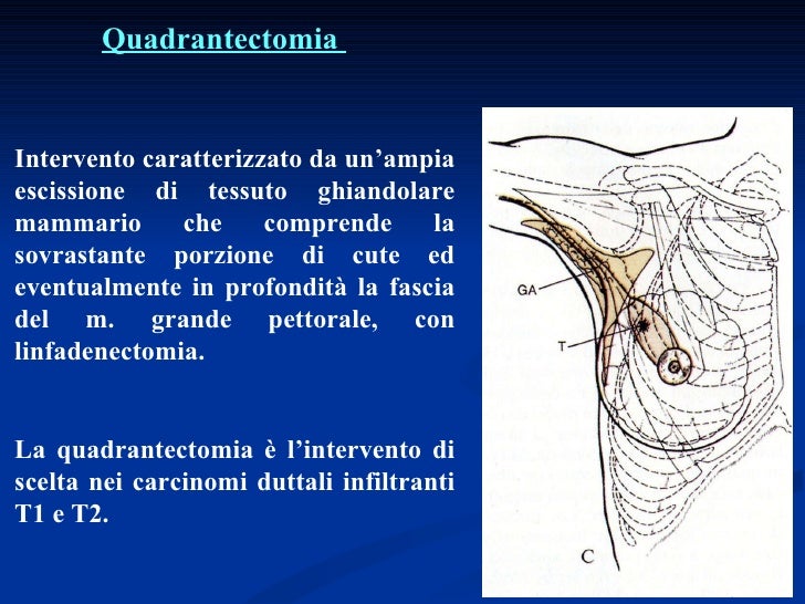 Linee Guida Lesioni B3 Mammella M.remedi, la chirurgia del carcinoma della mammella
