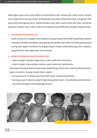 Modul Pendidikan Jarak Jauh Pendidikan Tinggi Kesehatan
59
kekeringan pada mata yang disebut Xerophthalmia dan mempunyai risiko untuk menjadi
buta. Gejala klinis Kurang Vitamin A (KVA) pada mata akan timbul bila tubuh mengalami KVA
yang telah berlangsung lama. Gejala tersebut akan lebih cepat timbul bila anak menderita
penyakit campak, diare, Infeksi Saluran Pernafasan Akut (ISPA) dan penyakit infeksi lainnya.
1.	 Penyebab gangguan gizi
Salah satu jenis kurang gizi makro adalah kurang energi protein (KEP) yang terjadi apabila
seorang anak tidak mendapat cukup energi atau protein dari makanan.Seorang anak yang
sering sakit dapat menderita kurang gizi.Napsu makan anak berkurang, dan makanan
yang dimakan tidak digunakan secara efisien.
2.	 Apabila seorang anak kurang gizi:
•	 Anak mungkin tampak sangat kurus, suatu tanda dari marasmus.
•	 Anak mungkin menunjukkan edema, suatu tanda dari kwashiorkor.
Seorang anak yang makanannya kurang mengandung vitamin dan mineral yang dianjurkan,
dapat menderita kurang zat gizi mikro, seperti :
•	 Kurang vitamin A mempunyai risiko lebih besar menderita kebutaan.
•	 Kurang asupan makanan yang mengandung yodium akan menyebabkan pertumbuhan
dan perkembangan anak terganggu (kretin).
Gambar : kwashiorkor salah satu tanda kekurangan gizi
 