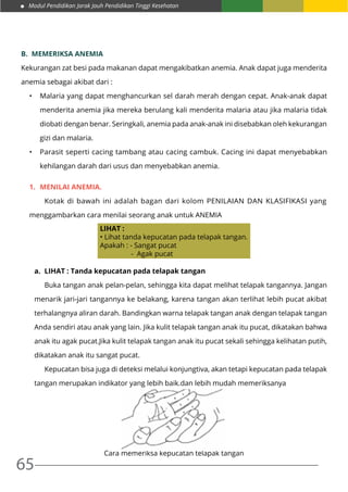 Modul Pendidikan Jarak Jauh Pendidikan Tinggi Kesehatan
65
B.	 MEMERIKSA ANEMIA
Kekurangan zat besi pada makanan dapat mengakibatkan anemia. Anak dapat juga menderita
anemia sebagai akibat dari :
•	 Malaria yang dapat menghancurkan sel darah merah dengan cepat. Anak-anak dapat
menderita anemia jika mereka berulang kali menderita malaria atau jika malaria tidak
diobati dengan benar. Seringkali, anemia pada anak-anak ini disebabkan oleh kekurangan
gizi dan malaria.
•	 Parasit seperti cacing tambang atau cacing cambuk. Cacing ini dapat menyebabkan
kehilangan darah dari usus dan menyebabkan anemia.
1.	 MENILAI ANEMIA.
	 Kotak di bawah ini adalah bagan dari kolom PENILAIAN DAN KLASIFIKASI yang
menggambarkan cara menilai seorang anak untuk ANEMIA
LIHAT :
• Lihat tanda kepucatan pada telapak tangan.
Apakah : - Sangat pucat
- Agak pucat
a.	 LIHAT : Tanda kepucatan pada telapak tangan
	 Buka tangan anak pelan-pelan, sehingga kita dapat melihat telapak tangannya. Jangan
menarik jari-jari tangannya ke belakang, karena tangan akan terlihat lebih pucat akibat
terhalangnya aliran darah. Bandingkan warna telapak tangan anak dengan telapak tangan
Anda sendiri atau anak yang lain. Jika kulit telapak tangan anak itu pucat, dikatakan bahwa
anak itu agak pucat.Jika kulit telapak tangan anak itu pucat sekali sehingga kelihatan putih,
dikatakan anak itu sangat pucat.
	 Kepucatan bisa juga di deteksi melalui konjungtiva, akan tetapi kepucatan pada telapak
tangan merupakan indikator yang lebih baik.dan lebih mudah memeriksanya
					
Cara memeriksa kepucatan telapak tangan
 