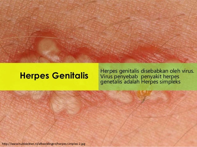 Herpes genitalis partnersuche