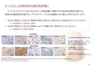 4
ケース① <生体材料の適合性評価>
Ge LP, et al. (2015)
Integration of nondegradable polystyrene and degradable gelatin in a core–sheath nanofibrous patch for pelvic reconstruction.
Int J Nanomedicine. 2015 Apr 24;10:3193-201.
https://www.ncbi.nlm.nih.gov/pubmed/25995629
　インプラントやステントなどのような人工物を組織へ埋植する生体材料の開発分野では、
術後の治癒段階を評価する上でマクロファージの局在観察に高く関心が寄せられています。
●
M1型の集簇が主であれば、埋植物が異物と見做され、貪食作用により腐食を受けていることを示す。
　　⇒ 生体材料として適さない素材。
●
M2型の集簇が主であれば、埋植物へ向かって組織が再生・修復されていることを示す。
　　⇒ 生体材料として適する素材。
生分解性埋植素材の埋植予後。
M1型の集簇が少ない一方で、
M2型は2週間後をpeakにして
多くの集簇が認められる。
3週間以降はどちらも
あまり集簇が認められない。
⇒ 殆ど炎症を来すことなく
　3-4週間程度で定着完了。
伊純 明寛
 