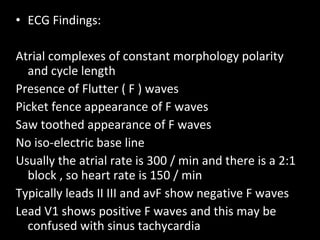 ECG Findings: Atrial complexes of constant morphology polarity and cycle length Presence of Flutter ( F ) waves Picket fence appearance of F waves Saw toothed appearance of F waves No iso-electric base line Usually the atrial rate is 300 / min and there is a 2:1 block , so heart rate is 150 / min Typically leads II III and avF show negative F waves Lead V1 shows positive F waves and this may be confused with sinus tachycardia 