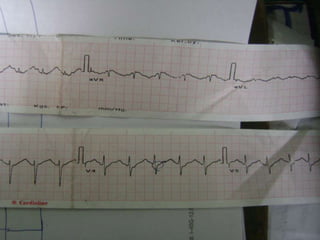 ECG