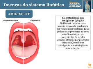 Doenças do sistema linfático
AMIGDALITE
É a inflamação das
amígdalas (gânglios
linfáticos), devida a uma
infeção provocada geralmente
por vírus ou por bactérias. Estes
podem estar presentes no ar ou
nos alimentos ou ser
provenientes de tecidos
vizinhos afetados por processos
infeciosos, como uma
constipação, uma faringite ou
uma laringite.
Infeção viralInfeção bacteriana
 