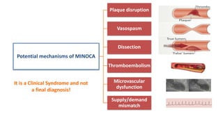 Potential mechanisms of MINOCA
Plaque disruption
Vasospasm
Dissection
Thromboembolism
Microvascular
dysfunction
Supply/demand
mismatch
It is a Clinical Syndrome and not
a final diagnosis!
 