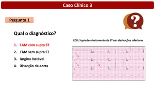 Caso Clínico 3
Pergunta 1
Qual o diagnóstico?
1. EAM com supra ST
2. EAM sem supra ST
3. Angina Instável
4. Disseção da aorta
ECG: Supradesnivelamento de ST nas derivações inferiores
 