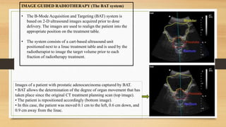 Precision Radiotherapy: Tailoring Treatment for Individualised Cancer ...