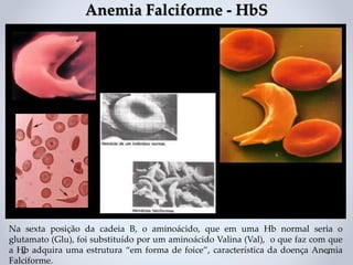 Na sexta posição da cadeia B, o aminoácido, que em uma Hb normal seria o
glutamato (Glu), foi substituído por um aminoácido Valina (Val), o que faz com que
a Hb adquira uma estrutura “em forma de foice”, característica da doença Anemia
Falciforme.
Anemia Falciforme - HbS
 
