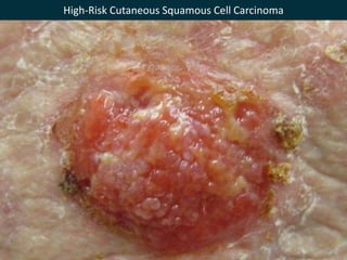 High-Risk Cutaneous Squamous Cell Carcinoma
 