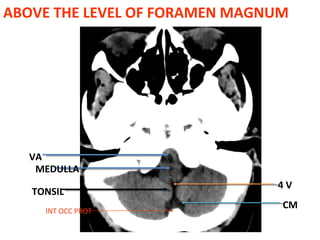 ABOVE THE LEVEL OF FORAMEN MAGNUM VA MEDULLA TONSIL 4 V CM INT OCC PROT 