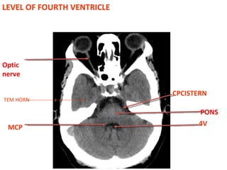 LEVEL OF FOURTH VENTRICLE MCP CPCISTERN PONS 4V TEM HORN Optic nerve 