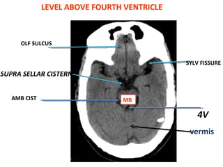 LEVEL ABOVE FOURTH VENTRICLE SUPRA SELLAR CISTERN MB AMB CIST SYLV FISSURE 4V OLF SULCUS vermis 