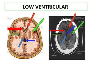 LOW VENTRICULAR  