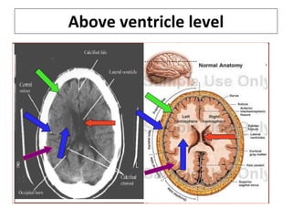 Above ventricle level 