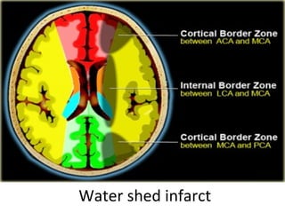 Water shed infarct 