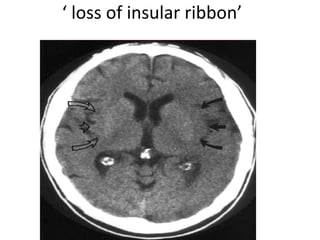 ‘  loss of insular ribbon’ 