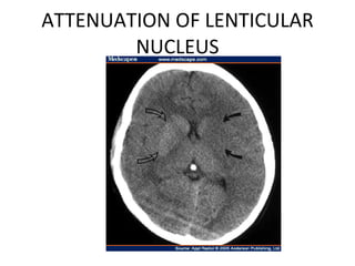 ATTENUATION OF LENTICULAR NUCLEUS 