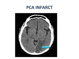 PCA INFARCT 