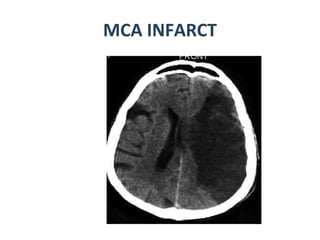 MCA INFARCT 