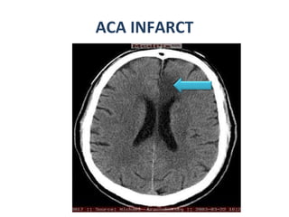 ACA INFARCT 