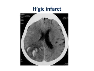 H’gic infarct 