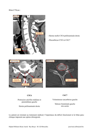 Bilan CTScan :




                                                            - Hernie molle C5C6 préforaminale droite

                                                            - Discarthrose C5C6 et C6C7




                          C5C6                                                C6C7

            Protrusion calcifiée médiane et                      Volumineuse uncarthrose gauche
                 paramédiane gauche
                                                                    Sténose foraminale gauche
              Hernie préforaminale droite                                   très serrée



Le patient est résistant au traitement médical; l’importance du déficit fonctionnel et le bilan para-
clinique imposent une option chirurgicale.




Hôpital Militaire Reine Astrid Rue Bruyn B-1120 Bruxelles                            jean-louis.leflot@mil.be
 
