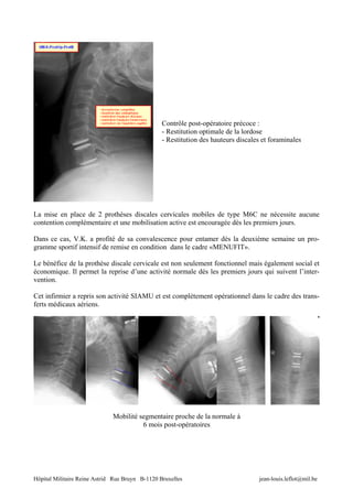 Contrôle post-opératoire précoce :
                                                 - Restitution optimale de la lordose
                                                 - Restitution des hauteurs discales et foraminales




La mise en place de 2 prothèses discales cervicales mobiles de type M6C ne nécessite aucune
contention complémentaire et une mobilisation active est encouragée dès les premiers jours.

Dans ce cas, V.K. a profité de sa convalescence pour entamer dès la deuxième semaine un pro-
gramme sportif intensif de remise en condition dans le cadre «MENUFIT».

Le bénéfice de la prothèse discale cervicale est non seulement fonctionnel mais également social et
économique. Il permet la reprise d’une activité normale dès les premiers jours qui suivent l’inter-
vention.

Cet infirmier a repris son activité SIAMU et est complètement opérationnel dans le cadre des trans-
ferts médicaux aériens.




                              Mobilité segmentaire proche de la normale à
                                        6 mois post-opératoires




Hôpital Militaire Reine Astrid Rue Bruyn B-1120 Bruxelles                          jean-louis.leflot@mil.be
 