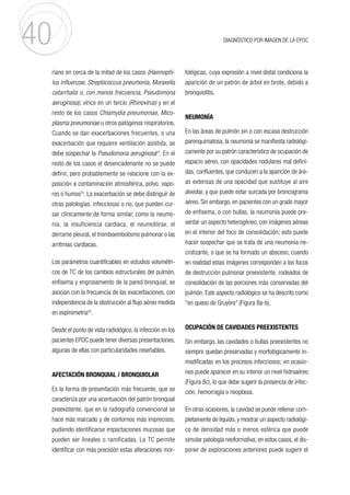 40 DIAGNÓSTICO POR IMAGEN DE LA EPOC
riano en cerca de la mitad de los casos (Haemophi-
lus influenzae, Streptococcus pneumonia, Moraxella
catarrhalis o, con menos frecuencia, Pseudomona
aeruginosa), vírico en un tercio (Rhinovirus) y en el
resto de los casos Chlamydia pneumoniae, Mico-
plasma pneumoniae u otros patógenos respiratorios.
Cuando se dan exacerbaciones frecuentes, o una
exacerbación que requiere ventilación asistida, se
debe sospechar la Pseudomona aeruginosa24
. En el
resto de los casos el desencadenante no se puede
definir, pero probablemente se relacione con la ex-
posición a contaminación atmosférica, polvo, vapo-
res o humos25
. La exacerbación se debe distinguir de
otras patologías, infecciosas o no, que pueden cur-
sar clínicamente de forma similar, como la neumo-
nía, la insuficiencia cardíaca, el neumotórax, el
derrame pleural, el tromboembolismo pulmonar o las
arritmias cardíacas.
Los parámetros cuantificables en estudios volumétri-
cos de TC de los cambios estructurales del pulmón,
enfisema y engrosamiento de la pared bronquial, se
asocian con la frecuencia de las exacerbaciones, con
independencia de la obstrucción al flujo aéreo medida
en espirometría26
.
Desde el punto de vista radiológico, la infección en los
pacientes EPOC puede tener diversas presentaciones,
algunas de ellas con particularidades reseñables.
AFECTACIÓN BRONQUIAL / BRONQUIOLAR
Es la forma de presentación más frecuente, que se
caracteriza por una acentuación del patrón bronquial
preexistente, que en la radiografía convencional se
hace más marcado y de contornos más imprecisos,
pudiendo identificarse impactaciones mucosas que
pueden ser lineales o ramificadas. La TC permite
identificar con más precisión estas alteraciones mor-
fológicas, cuya expresión a nivel distal condiciona la
aparición de un patrón de árbol en brote, debido a
bronquiolitis.
NEUMONÍA
En las áreas de pulmón sin o con escasa destrucción
parenquimatosa, la neumonía se manifiesta radiológi-
camente por su patrón característico de ocupación de
espacio aéreo, con opacidades nodulares mal defini-
das, confluentes, que conducen a la aparición de áre-
as extensas de una opacidad que sustituye al aire
alveolar, y que puede estar surcada por broncograma
aéreo. Sin embargo, en pacientes con un grado mayor
de enfisema, o con bullas, la neumonía puede pre-
sentar un aspecto heterogéneo, con imágenes aéreas
en el interior del foco de consolidación; esto puede
hacer sospechar que se trata de una neumonía ne-
crotizante, o que se ha formado un absceso, cuando
en realidad estas imágenes corresponden a los focos
de destrucción pulmonar preexistente, rodeados de
consolidación de las porciones más conservadas del
pulmón. Este aspecto radiológico se ha descrito como
“en queso de Gruyère” (Figura 8a-b).
OCUPACIÓN DE CAVIDADES PREEXISTENTES
Sin embargo, las cavidades o bullas preexistentes no
siempre quedan preservadas y morfológicamente in-
modificadas en los procesos infecciosos; en ocasio-
nes puede aparecer en su interior un nivel hidroaéreo
(Figura 8c), lo que debe sugerir la presencia de infec-
ción, hemorragia o neoplasia.
En otras ocasiones, la cavidad se puede rellenar com-
pletamente de líquido, y mostrar un aspecto radiológi-
co de densidad más o menos esférica que puede
simular patología neoformativa; en estos casos, el dis-
poner de exploraciones anteriores puede sugerir el
 