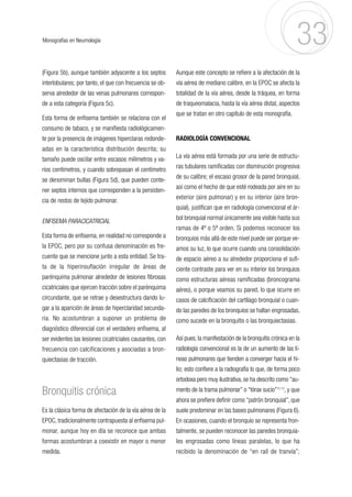 (Figura 5b), aunque también adyacente a los septos
interlobulares; por tanto, el que con frecuencia se ob-
serva alrededor de las venas pulmonares correspon-
de a esta categoría (Figura 5c).
Esta forma de enfisema también se relaciona con el
consumo de tabaco, y se manifiesta radiológicamen-
te por la presencia de imágenes hiperclaras redonde-
adas en la característica distribución descrita; su
tamaño puede oscilar entre escasos milímetros y va-
rios centímetros, y cuando sobrepasan el centímetro
se denominan bullas (Figura 5d), que pueden conte-
ner septos internos que corresponden a la persisten-
cia de restos de tejido pulmonar.
ENFISEMA PARACICATRICIAL
Esta forma de enfisema, en realidad no corresponde a
la EPOC, pero por su confusa denominación es fre-
cuente que se mencione junto a esta entidad. Se tra-
ta de la hiperinsuflación irregular de áreas de
parénquima pulmonar alrededor de lesiones fibrosas
cicatriciales que ejercen tracción sobre el parénquima
circundante, que se retrae y desestructura dando lu-
gar a la aparición de áreas de hiperclaridad secunda-
ria. No acostumbran a suponer un problema de
diagnóstico diferencial con el verdadero enfisema, al
ser evidentes las lesiones cicatriciales causantes, con
frecuencia con calcificaciones y asociadas a bron-
quiectasias de tracción.
Bronquitis crónica
Es la clásica forma de afectación de la vía aérea de la
EPOC, tradicionalmente contrapuesta al enfisema pul-
monar, aunque hoy en día se reconoce que ambas
formas acostumbran a coexistir en mayor o menor
medida.
Aunque este concepto se refiere a la afectación de la
vía aérea de mediano calibre, en la EPOC se afecta la
totalidad de la vía aérea, desde la tráquea, en forma
de traqueomalacia, hasta la vía aérea distal, aspectos
que se tratan en otro capítulo de esta monografía.
RADIOLOGÍA CONVENCIONAL
La vía aérea está formada por una serie de estructu-
ras tubulares ramificadas con disminución progresiva
de su calibre; el escaso grosor de la pared bronquial,
así como el hecho de que esté rodeada por aire en su
exterior (aire pulmonar) y en su interior (aire bron-
quial), justifican que en radiología convencional el ár-
bol bronquial normal únicamente sea visible hasta sus
ramas de 4º o 5º orden. Si podemos reconocer los
bronquios más allá de este nivel puede ser porque ve-
amos su luz, lo que ocurre cuando una consolidación
de espacio aéreo a su alrededor proporciona el sufi-
ciente contraste para ver en su interior los bronquios
como estructuras aéreas ramificadas (broncograma
aéreo), o porque veamos su pared, lo que ocurre en
casos de calcificación del cartílago bronquial o cuan-
do las paredes de los bronquios se hallan engrosadas,
como sucede en la bronquitis o las bronquiectasias.
Así pues,la manifestación de la bronquitis crónica en la
radiología convencional es la de un aumento de las lí-
neas pulmonares que tienden a converger hacia el hi-
lio; esto confiere a la radiografía lo que, de forma poco
ortodoxa pero muy ilustrativa, se ha descrito como “au-
mento de la trama pulmonar” o “tórax sucio”12-13
, y que
ahora se prefiere definir como “patrón bronquial”, que
suele predominar en las bases pulmonares (Figura 6).
En ocasiones, cuando el bronquio se representa fron-
talmente, se pueden reconocer las paredes bronquia-
les engrosadas como líneas paralelas, lo que ha
recibido la denominación de “en raíl de tranvía”;
33
Monografías en Neumología
 