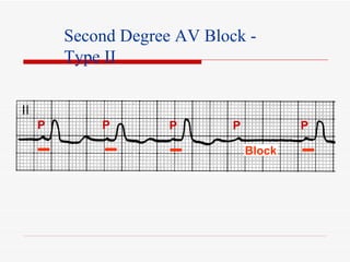ECG: Conduction Block | PPT