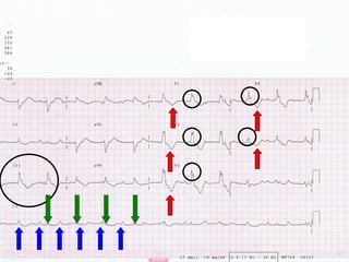 ECG: Conduction Block | PPT