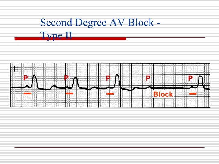 ECG Conduction Block