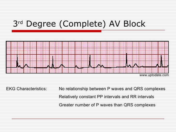 ECG Conduction Block