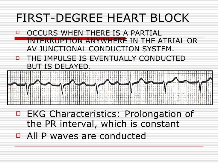 ECG Conduction Block
